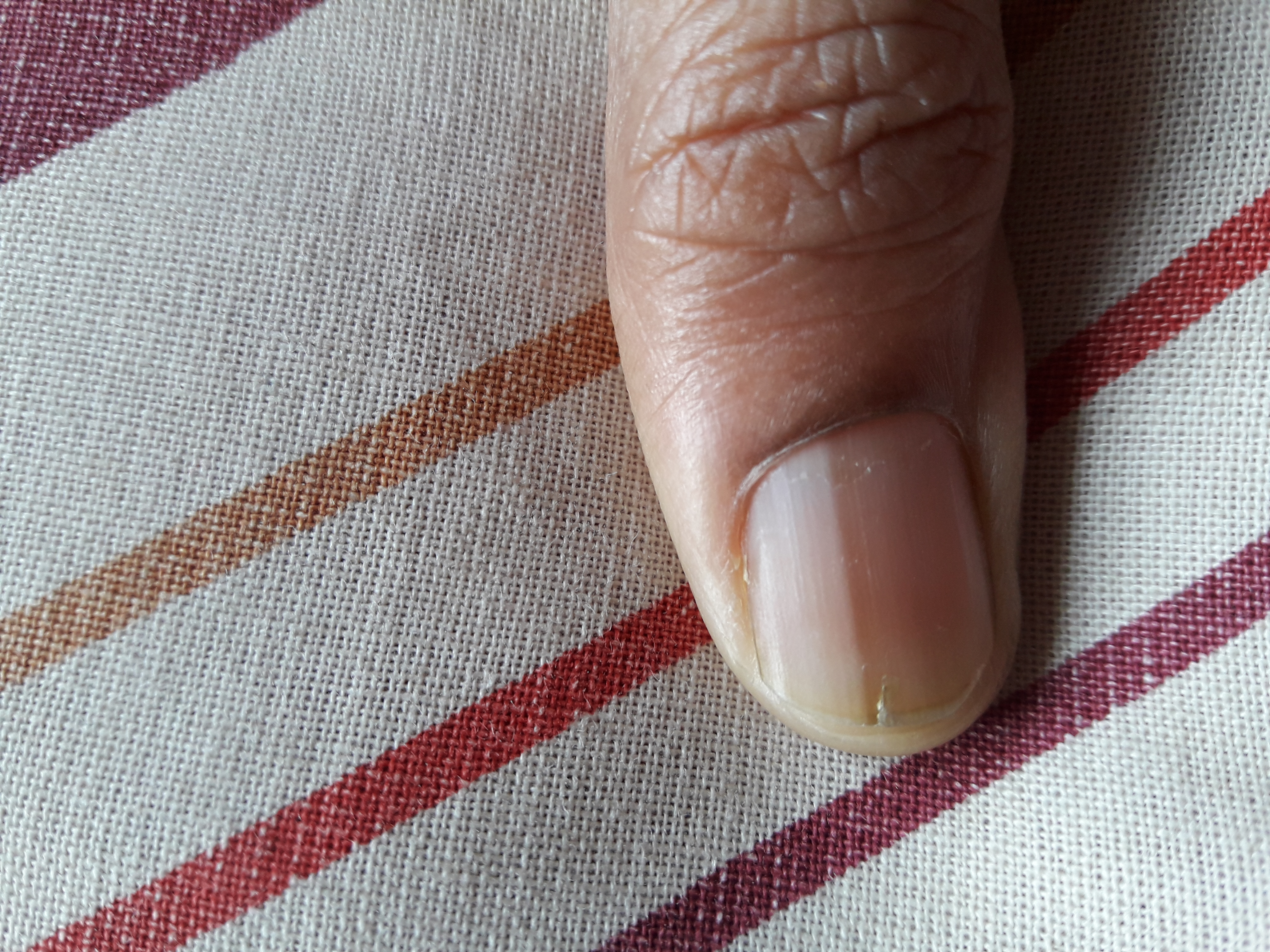 Cracked Thumb Nail With No Pain Or Tenderness